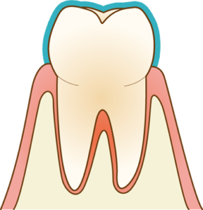 フッ素塗布｜橋本駅の歯医者　翼歯科口腔クリニック