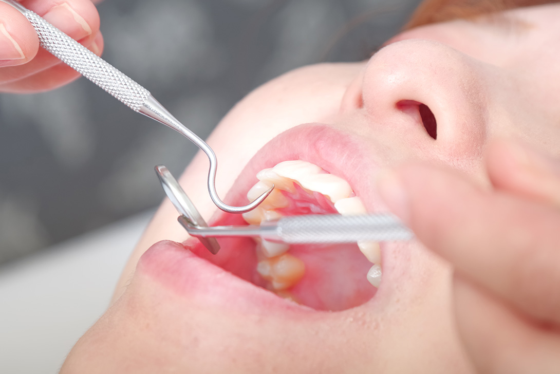 虫歯の治療｜橋本駅の歯医者　翼歯科口腔クリニック