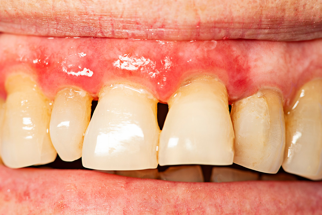 歯周病治療｜橋本駅の歯医者　翼歯科口腔クリニック