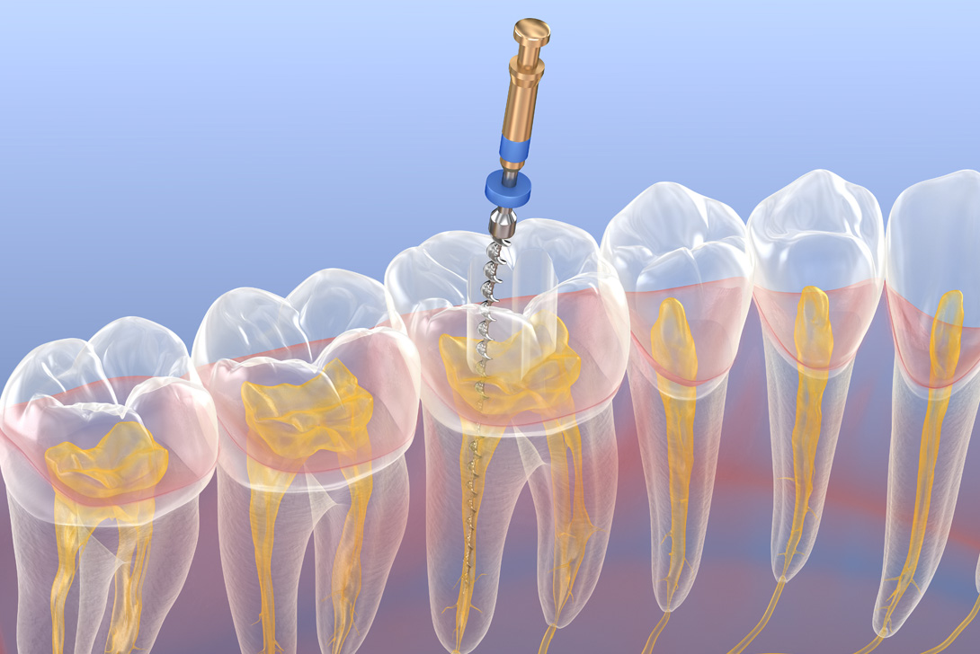 根管治療|橋本駅の歯医者 翼歯科口腔クリニック