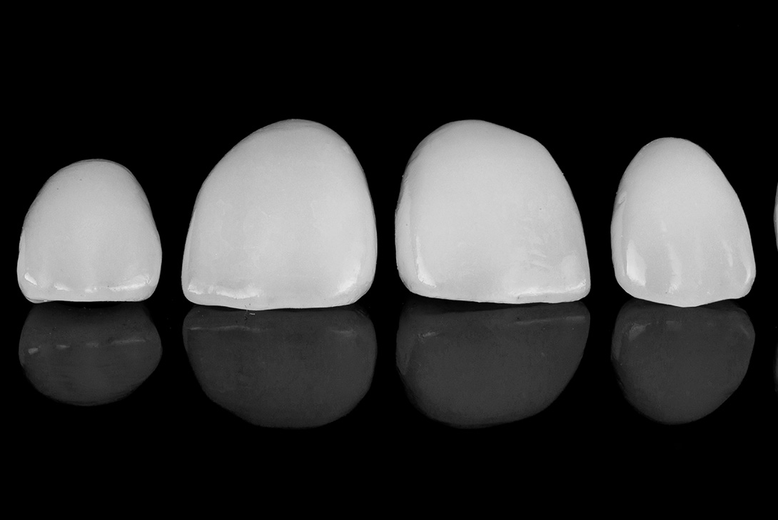 詰め物・被せ物｜橋本駅の歯医者　翼歯科口腔クリニック