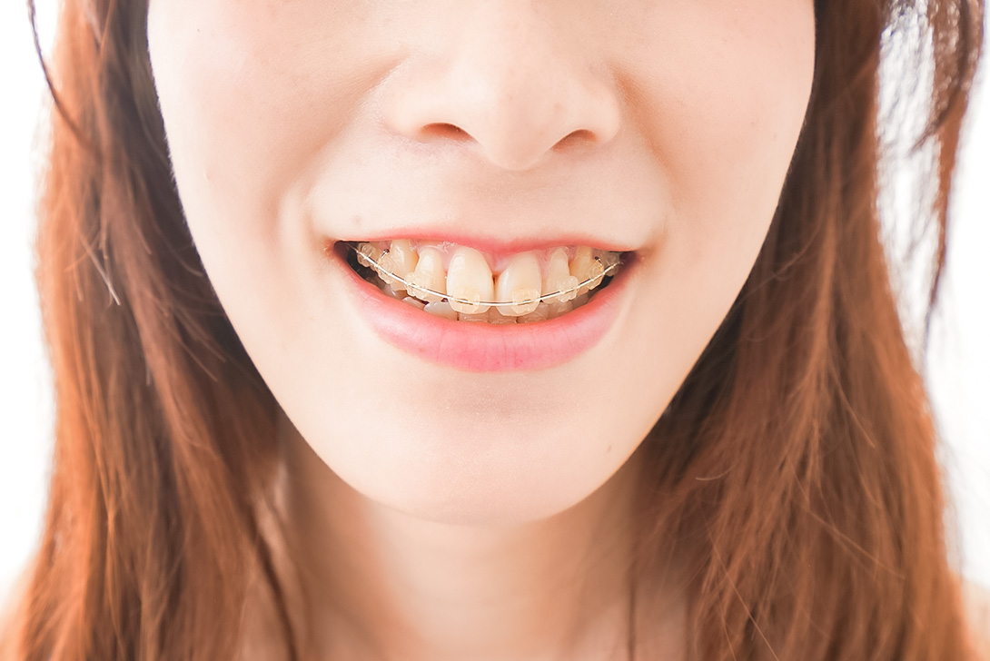 大人の矯正について｜橋本駅の歯医者　翼歯科口腔クリニック