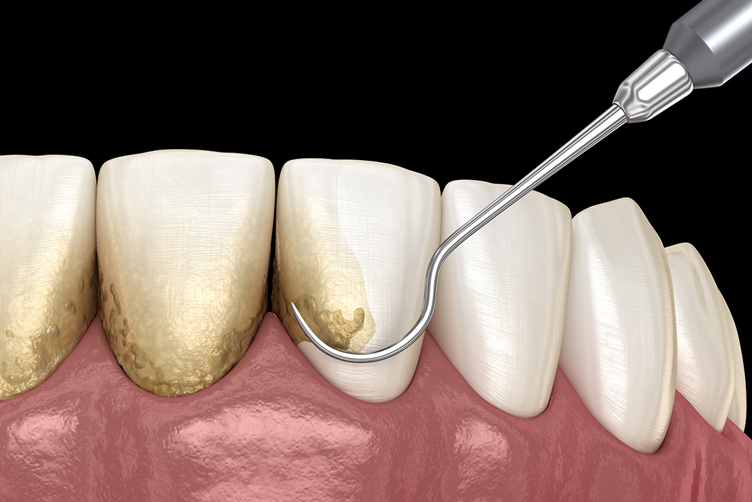 定期検診｜橋本駅の歯医者　翼歯科口腔クリニック