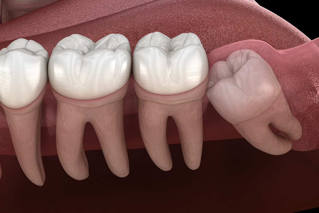 親知らずの抜歯｜