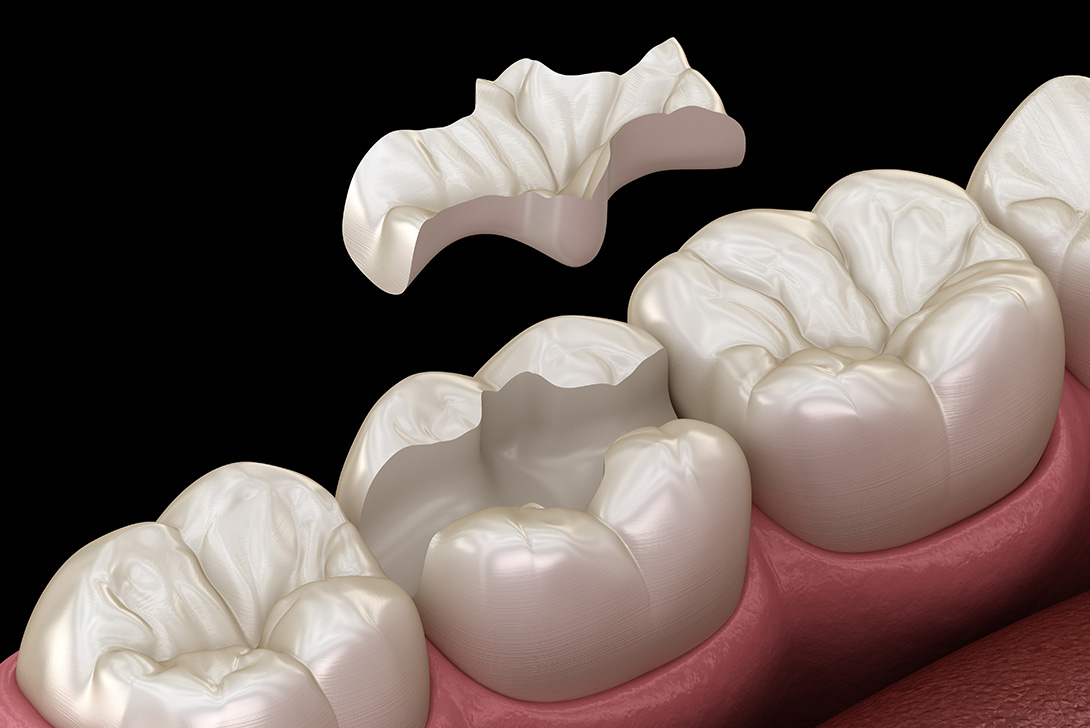 マイクロスコープの使用するケース|審美治療や詰め物・被せ物の治療