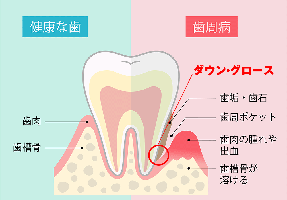 歯周病｜橋本駅・翼歯科口腔クリニック